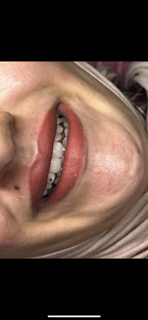 Filler Lèvres & Blanchiment Dentaire